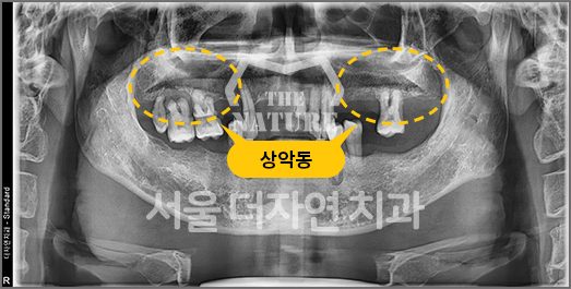 상악동거상술 — 상악동 위치와 위 어금니 임플란트 식립 엑스레이